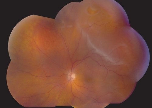 Figure 1 Primary rhegmatogenous retinal detachment, left eye, with a flap retinal tear at 1:00.
