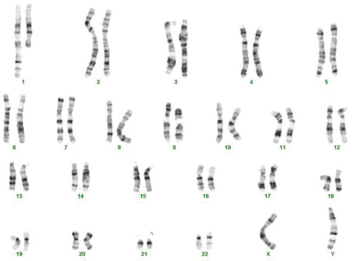 Figure 3. Karyotype of the patient showing 46,X,t(Y;1)(q12;q21) and a pericentric inversion of chromosome 9: inv (9)(p12;q13)