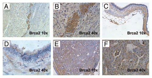 Figure 4 Brca2 immunohistochemistry confirms loss of protein expression in lesional pancreatic epithelium. (A and B) Brca2 immunohistochemistry confirms robust cytoplasmic expression in granulosa cells of the ovary, a known positive control (10× and 40″ magnification). (C and D) Minimal to absent Brca2 expression is observed within the lining epithelium of the degenerated cysts, a prototype of which is illustrated in Figure 2 (10× and 40× magnification). Note that the subjacent mesenchymal cells retain Brca2 expression. (E and F) Minimal to absent Brca2 expression is observed within mPanIN lesions arising in a “CPB” mouse (10× and 40× magnification).