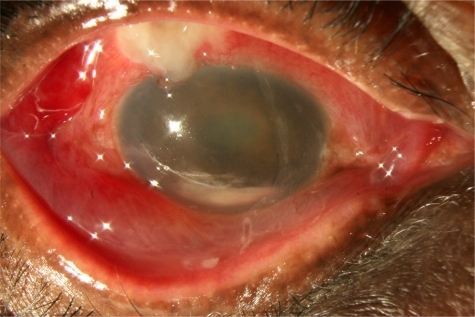 Figure 1 Photograph of right eye of 66-year-old male presenting with BAE from Streptococcus sp. Presenting VA: HM, IOP: 28 mmHg. Treatment: tap and injection. Final VA: HM, IOP: 12 mmHg. Culture-positive cases were associated with worse presenting VA and higher presenting IOP than culture-negative cases.