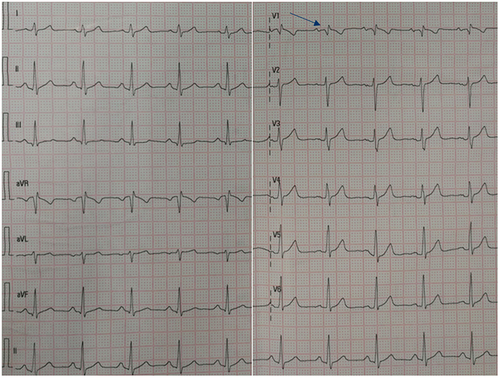 Figure 1 Electrocardiogram findings at the first admission. The arrow on electrocardiogram revealed an incomplete right bundle branch block (an R/S ratio >1 in lead V1).