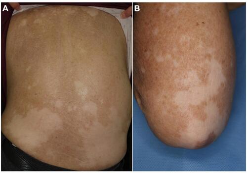 Figure 7 Vitiligo in patients with melanoma under nivolumab therapy (A) and lung cancer under pembrolizumab therapy (B).