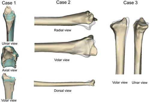 Figure 2. Mirroring the uninjured forearm (transparent blue or grey) over the injured side (beige).