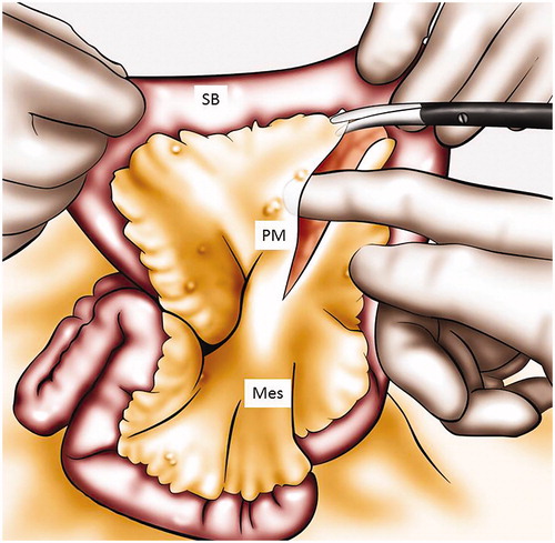 Figure 4. Mesenteric peritonectomy. A peritonectomy of the mesentery is performed. SB: small bowel; Mes: mesentery; PM: peritoneum of the mesentery.
