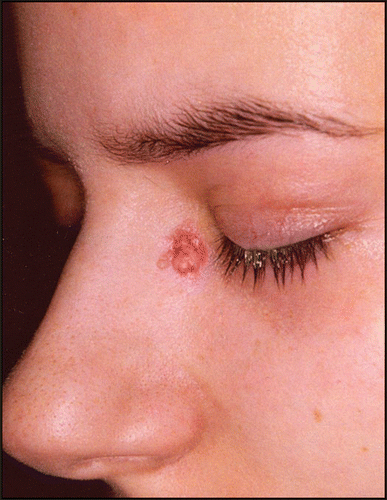 Figure 1 A 17-year-old girl with an asymptomatic, unilateral, papillomatous, pale, erythematous nodule at the inner angle of the left eye