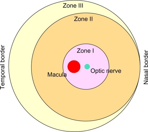 Figure 1 Schematic of retinal zones.