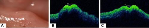 Figure 4 (A and B) Before treatment: Slit lamp examination showed barely visible punctum. Anterior segment optical coherence tomography (AS-OCT) image revealed outer punctal diameter (OPD) of 443 µm (white line) with very shallow punctal depth (PD). (C) One month after treatment: AS-OCT image revealed minimal increase of OPD to 490 µm (white line) meanwhile neither vertical canaliculus lumen nor inner punctal opening was restored.