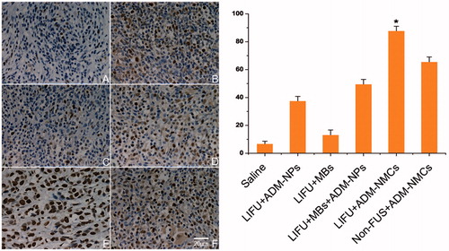 Figure 7. The left panel indicates the expression of apoptotic cells in tumor using immunohistochemical staining after each treatment. More apoptotic cells were seen in group E in comparison to the other groups (*p < 0.05). (A) Control group; (B) ADM-NPs + LIFU; (C) MBs + LIFU; (D) ADM-NPs + MBs + LIFU; (E) ADM-NMCs + LIFU; (f) ADM-NMCs + non-FUS. The right is the apoptotic index (AI) of tumor tissue in each group (*p < 0.05).