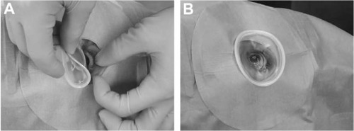 Figure 4 LiDrape® attachment procedure. (A) The device was attached by pulling up the upper lid while folding the top ring and inserting the bottom ring into the upper conjunctival sac and then into the lower conjunctival sac. (B) The device attached to the eye.