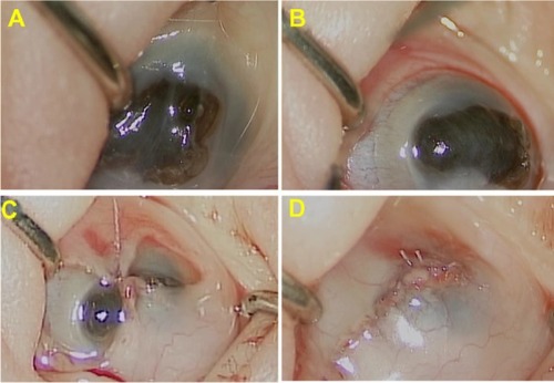 Figure 2 Intraoperative findings. Iris protrusion and a fat anterior chamber were observed.