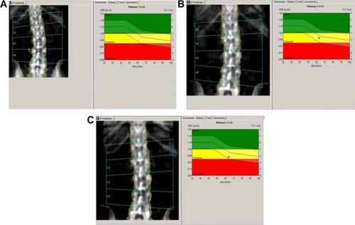 Figure 4 Lumbar spine bone mass density over time. (A) At baseline, (B) at 12 months, and (C) at 24 months.
