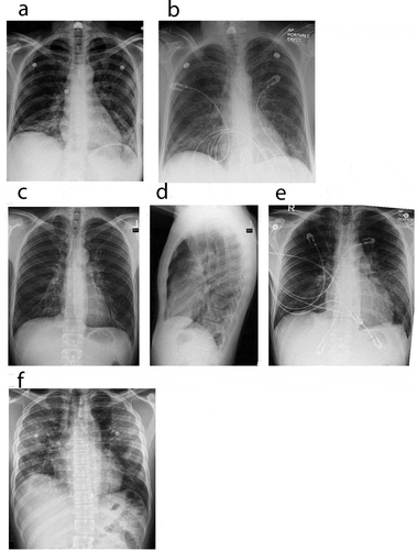 Figure 1. Chest X ray. Chest radiographs depicting a spectrum of EVALI. (a) and (b) Chest radiographs of case 1. (a) (Day 1 of admission, pre-treatment), revealed bi-basilar haziness whereas (b) (steroid day 2), demonstrated mild improvement of left lower lobe infiltrates. (c–e) Chest radiographs of case 2. (c, d) (Day 1 of admission, pre-treatment), revealed minimal infiltrates bilaterally. Punctate density of the left upper chest is suggestive of a calcified granuloma (c), with lateral view (d) showing minimal infiltrate. (e) (steroid day 3), demonstrates clinical improvement in bilateral infiltrates. (f) Chest radiograph of case 3. (f) (Day 1 of admission, pre-treatment), revealed patchy infiltrates bilaterally