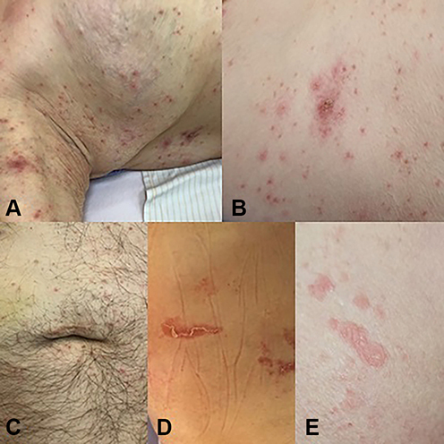 Figure 6 Photographs of skin manifestations in presented cases (A) Case 1; (B) Case 2; (C) Case 3; (D) Case 4; (E) Case 5.