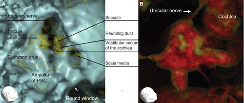 Figure 3. Representative 3DCT images of the right ear of a patient with Meniere’s disease. (A) Image obtained using CT window values (CTWVs) of CaCO3 (yellow) and bone (blue). (B) Image obtained using CTWV of CaCO3 (yellow) and water (red). PSC, Posterior semicircular canal.