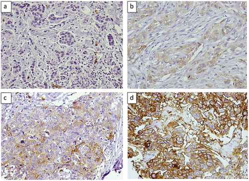 Figure 1. Cytoplasmic expression of GLUT1 in breast cancer. a: negative stain (20X); b: weak positive stain (20 X); c: moderate positive stain (20 X); d: strong positive stain (20X).