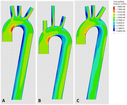 Figure 2. Velocity pattern. A) 50th per centile, B) minimal and C) ellipsoidal anatomy.