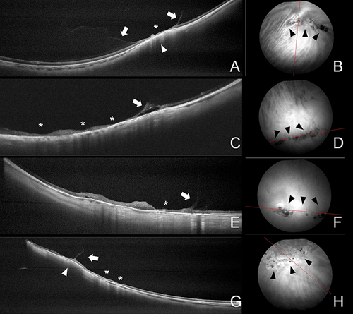 Figure 3 Optical coherence tomography findings in lattice degeneration. (A) Cross-sectional scan passing the lesion crosswise demonstrates U-shaped vitreous adhesion and liquification (arrows), retinal and choroidal thinning (asterisk), and dome-shaped scleral indentation (arrowhead). (B) Corresponding infrared image shows perivascular moderately pigmented lesion (black arrowheads) (position of the scan is indicated by the red line). (C) Cross-sectional scan passing along the lesion demonstrates retinal and choroidal thinning (asterisks) and retinal separation (arrow). (D) Corresponding infrared image shows concentrical highly pigmented lesion (black arrowheads) (position of the scan is indicated by the red line). (E) Cross-sectional scan passing along the lesion demonstrates retinal and choroidal thinning (asterisks) and vitreous traction (arrow). (F) Corresponding infrared image shows concentrical mildly pigmented lesion with chorioretinal atrophy (black arrowheads) (position of the scan is indicated by the red line). (G) Cross-sectional scan passing the lesion crosswise demonstrates chorioretinal scars after laser photocoagulation (asterisks), “blunted” vitreous traction (arrow), and dome-shaped scleral indentation (arrowhead). (H) Corresponding infrared image shows mildly pigmented lesion surrounded by chorioretinal scars after laser photocoagulation (black arrowheads) (position of the scan is indicated by the red line).