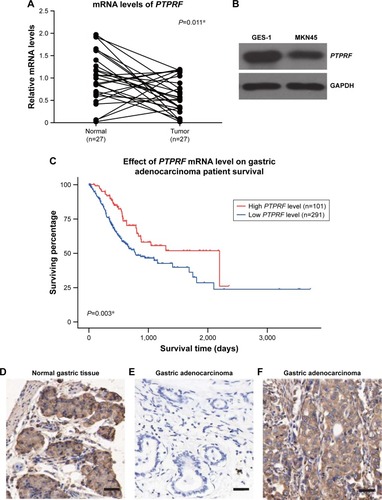 Figure 1 PTPRF is downregulated in gastric adenocarcinoma tissue.