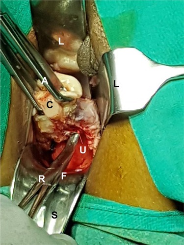 Figure 2 The tip of a right angle forceps (PTVH forceps; R) was inserted into the plane between uterus and uterosacral ligament (U, arrow) of left side.
