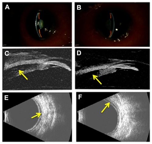 Figure 1 Slit-lamp photographs of the right (A) and left (B) eye demonstrating moderate peripheral and central anterior chamber shallowing after recent ingestion of methazolamide. High-frequency (35 MHz) ultrasound biomicroscopy reveals anterior displacement of the lens–iris diaphragm due to ciliary body edema and supraciliary effusion (arrows) in the right (C) and left (D) eye. Anterior chamber depth measured 1.2 mm in each eye and lens thickness measured 4.8 mm and 4.9 mm in the right and left eye, respectively. B-scan ultrasonography revealed shallow posterior choroidal effusions (arrows) in the right (E) and left (F) eye.