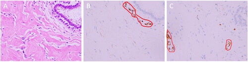 Figure 4. Postoperative pathology of the breast. Microscopically, the mammary stromal cells proliferated and formed overlapping fissures. Spindle cells were attached, they were mild in shape, with no obvious atypia, and no mitotic image of the nucleus was found (A, hematoxylin and eosin (H&E) staining, ×400). Immunohistochemistry (IHC): Interstitial cells were positive for CD34 staining (Figure E, streptavidin-perosidase (SP) conjugated method, ×400) and negative for CD31 staining (Figure F, streptavidin-perosidase (SP) conjugated method, ×400). CD34 was expressed in the cytoplasm (shown in brown), and the nucleus is shown in blue. However, the vascular endothelial cells were positive for CD31 staining, which is expressed in the cytoplasm, shown in brown (red-circled areas in B and C). IHC, Immunohistochemistry.