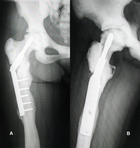 Figure 4 The X-ray examination results (A, B) showed complete healing of the subtrochanteric fracture and femoral neck fracture 2 years after surgery.