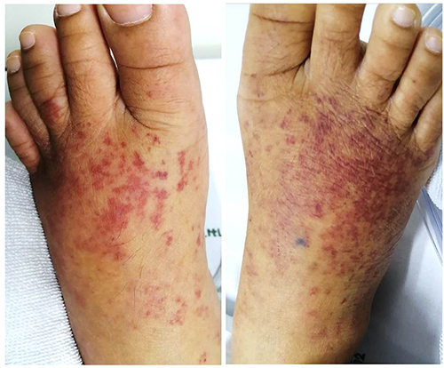 Figure 1 Multiple non-blanchable erythematous macules and patches on both dorsa of feet.