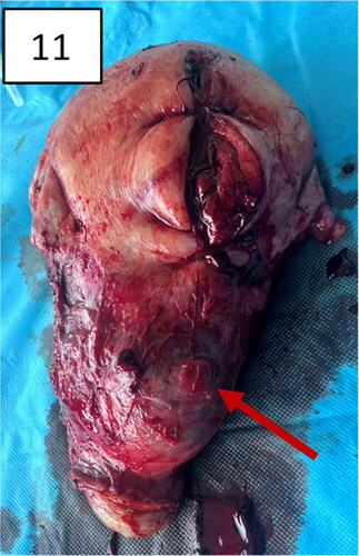 Figure 11. Hysterectomy with signs and markers of Figures 8–10, bulging in the lower uterine segment, including the cervix, specific for placenta accreta/percreta.