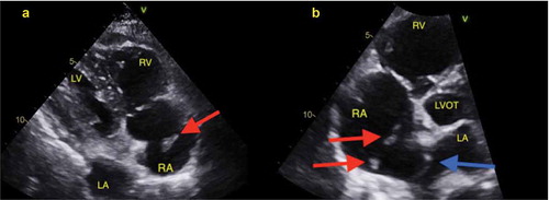 Figure 4. Two-dimensional transthoracic echocardiogram on day 2. (a): Subcostal view; showing echogenic nobile thrombus in the right atrium. RV: Right ventricle; RA: Right atrium; LA: Left atrium; LV: Left ventricle. Red arrow: mobile right atrial thrombus in transit. (b): Apical Four-chamber view. LVOT: Left ventricle outflow tract; LA: Left atrium; RV: Right Ventricle; RA: Right atrium; Red arrows showing right atrial thrombi. Blue arrow: Atrial septal aneurysm