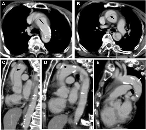Figure 2 CT scan images. (A) An axial plane CT showing dissections in the ascending (black arrow) and the descending aorta. The aortic arch is strongly calcified. (B) The false lumens were filled with contrast media (black arrow). (C) A sagittal plane of the truncal CT showing dissection in the ascending aorta with a false lumen filled with contrast media (black arrow) and dissection in the descending aorta. The false lumen in the descending aorta was patent to the true lumen in the proximal part and filled with thrombus in the distal part (white arrow). (D) The flaps in the ascending aorta seem to be connected to the calcified aortic arch (black arrow). (E) The distal end of calcified aortic arch is attached to the flap in the descending aorta (white arrow).