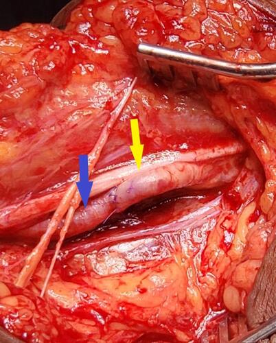 Figure 2 Filling of the brachial artery showing pre-arteriotomy site (yellow arrow), post-arteriotomy site (blue arrow) and oblique arteriotomy in between, after embolectomy.