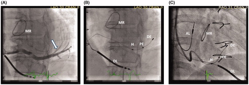 Figure 2. A) Fluoroscopic left anterior oblique view (LAO) demonstrates selective venogram of a posterolateral vein. The arrow indicates the target location for the left ventricular (LV) lead.B) LAO view of the final lead placement of an active fixation bipolar LV lead. The helix(H) is fixated proximal in the target vein. The proximal electrode (PE) is located in the basal third of the LV long- axis and is selected as the stimulating cathodal electrode. The distal electrode (DE) is in the mid third of the LV long-axis. The high voltage right ventricular defibrillator lead (DL) is located in the apex of the right ventricle.C) Demonstrate the final LV lead placement in right anterior oblique view (RAO). MR=mitral valve ring; AL=pacing lead located in the right atrial appendage.