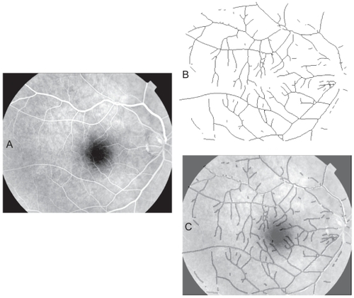 Figure 6 Automated segmentation of a retinal blood vessel pattern. A. The original fluorescein labeled image 18_393__. B. The automatically segmented and skeletonised vascular pattern from the image. C. The automatically segmented pattern from B, dilated to a uniform diameter and shown overlain on the original image as a dark vessel pattern over the fluorescein-labeled (white) vessels to illustrate the correspondence of the automatically selected pattern with vessels in the original.