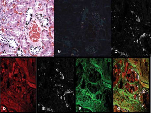 Fig. 1.  Oxalate crystals deposit within the renal tubules. (A) These deposits are laminated (in black) and (B) birefringent under polarized light (H&E x40); (C) visualization of the oxalate crystals deposits with confocal laser scanning microscope; (D) tubular epithelial cells with cytoplasmic swelling and acute necrosis; (E) birefringent crystals in the renal tubules; (F) scan for interstitial connective and (G) definitive evidence of calcium oxalate crystals within the renal tubules (in white); interstitial connective in green, erythrocytes in yellow and epithelial nuclei in red.