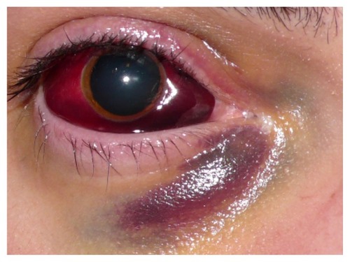Figure 2 This massive subconjunctival hemorrhage accompanied acute intralesional bleeding of an orbital arteriovenous malformation following strenuous physical exercise.