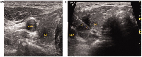 Figure 2. Hydrodissection technique. (A) On transverse image, the nodule is located adjacent to the common carotid artery. (B) 0.9 % normal saline is injected between the common carotid artery and the nodule to prevent needle-induced thermal injury. M = mass, CCA = common carotid artery. Arrowheads = microwave antenna.