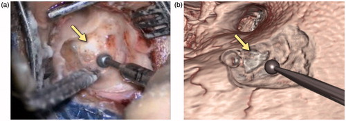 Figure 13. Snapshots comparing the actual (a) and virtual (b) procedures for a 12-year-old girl with a history of right-sided congenital cholesteatoma. She had previously undergone a two-stage tympanomastoidectomy with ossicular reconstruction, and subsequently presented with a maximal conductive loss and evidence of an ear canal cholesteatoma. She underwent right canalplasty with resection of external auditory canal cholesteatoma. The operative view shows the mastoidectomy performed to access the cholesteatoma (arrow) which has been segmented in white in the simulation view.