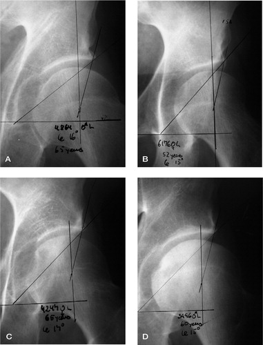 Figure 4 Moderate hip dysplasia without radiological signs of osteoarthrosis. A: male, 65 years, left hip; CE = 16°. B: female, 52 years, left hip; CE = 15°. C: female, 65 years, left hip; CE = 17°. D: male, 60 years, left hip; CE = 15°.