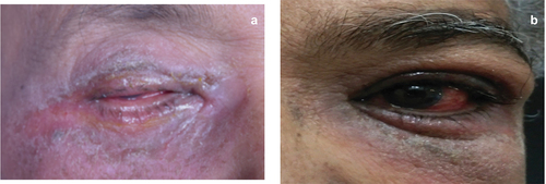 Figure 1. Periocular dermatitis and blepharitis with skin excoriation (a) and lichenification (b).