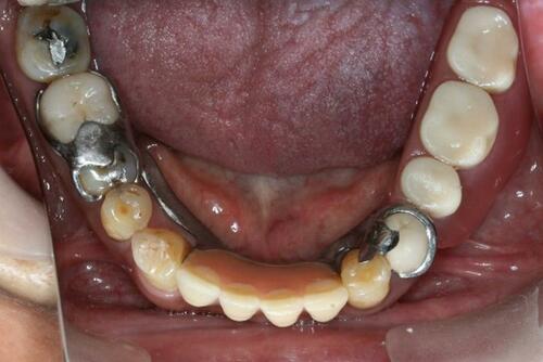 Figure 14 The denture 10 years after delivery (flipped mirror image).