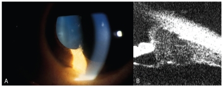 Figure 1 A, Large granuloma of the iris of OS. Keratic precipitates located on the lower part of corneal endothelium are also visible. B, Ultrasound biomicroscopy shows an homogenous, cystic-like lesion of the angle.