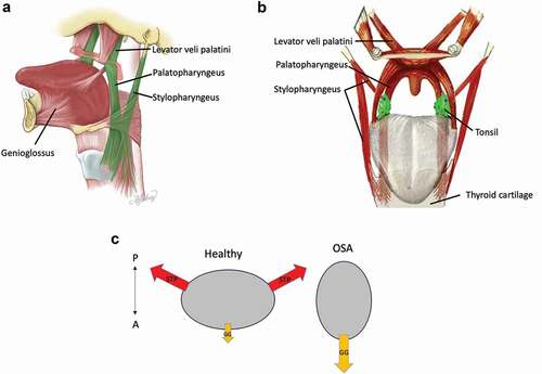 Figure 1. (a) Stylopharyngeus and the tandem action of palatopharyngeus and levator veli palatini support the thyroid cartilage from the skull base. (b)Stylopharyngeus and palatopharyngeus both insert in the tonsillar capsule (approximately at the blue dot) and on the thyroid cartilage. Through the interconnections in the tonsillar capsule, stylopharyngeus can keep the tonsils out of the airway, widen the oropharyngeal isthmus, and lower the Mallampati score. Not shown are the hyoid bone and stylopharyngeus’ interconnections with the pharyngeal constrictors, which will also widen the pharynx laterally. Figure is based on a public domain illustration available at: https://commons.wikimedia.org/wiki/File:Ротова_порожина.jpg, which was extensively modified by Dr. Dewald. (c) Differences in cross-sectional airway shapes can be explained by predominantly laterally oriented tension on the pharyngeal walls by stylopharyngeus (STP, red arrow) in healthy airways and predominantly anteriorly oriented tension by genioglossus (GG, Orange arrow) in OSA. Cross-sectional airway shapes based on reference [Citation10].