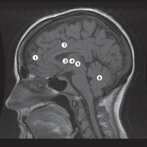 Figure 2 Sagittal magnetic resonance image demonstrating the sites of lesions for TS.