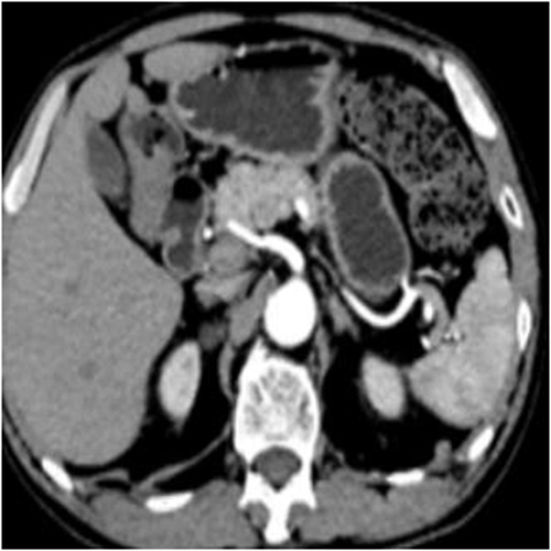 Figure 2 Initial computed tomography image showing no abnormalities in the abdomen.