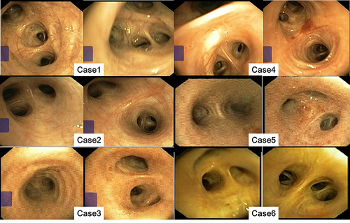 Figure 3 Bronchoscope imagings of all cases after hospitalization. All patients showed hyperemia and swelling of bronchial mucosa, significant exudation in the bronchi, and a little of white secretions in the segmental bronchi.