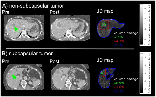 Figure 4. Exemplary results of two patients are demonstrated. (A) Pre- and post-interventional CT images of a 34-year-old female patient with a non-subcapsular located liver metastasis in segment 8 (green arrow) with 6.5 ml tumor volume with regional tissue alterations in zone 1 (green line) of −2.5 %, tissue shrinkage in zone 2 (red line) of +4.7% and similar tissue formation in the whole liver (blue line). (B) Pre- and post-interventional CT images of a 64-year-old female patient with a subcapsular liver metastases in segment 4 (green arrow) with 6.9 ml tumor volume with regional tissue alterations in zone 1 (green line) of +0.9%, +1.6 % in zone 2 (red line) and −0.1 % in the whole liver (blue line).