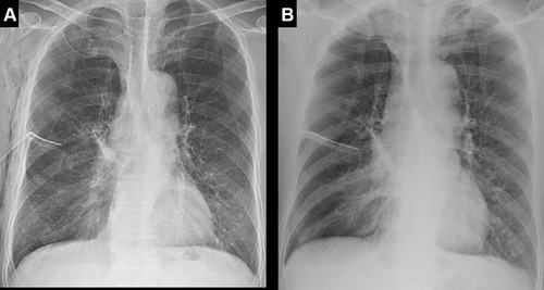 Figure 4 (A) Posterior-anterior chest X-ray taken before the procedure indicating severe emphysema and a huge bulla in the right lung. (B) Supine chest X-ray taken after the procedure, showing a mild volume decrease in the right upper lobe.
