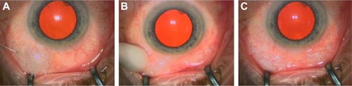 Figure 2 (A) MMC subconjunctival injection; (B) massage; (C) hydroexpansion.