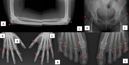 Figure 1. Periarticular calcifications (arrows) in the elbows, hands, and feet, before renal transplantation. L, left side; R, right side.