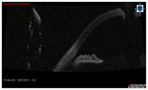 Figure 4 Anterior segment OCT 2 months following cryotherapy, showing closure of the cyclodialysis cleft. The patient had a contact intraocular pressure of 12 mmHg, with unaided Snellen visual acuity of 6/5.